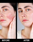 Arval Couperoll Emergency Cream SPF20 крем за редуциране на зачервявания 50 мл.