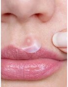 breakout + aid Emergency Dots For Spots and Blemishes локална грижа против акне на лицето деколтето и гърба с Tea Tree oil 72 бр.