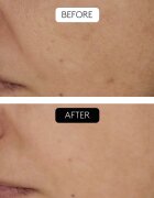 Cocunat Clinical Beauty Filler серум против стареене на кожата с микронидълинг 5 мл.