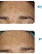 Dermedic Redness Calm крем против зачервяване и разширени капиляри 40 мл.