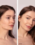 FOREO ESPADA™ 2 Plus писалка със синя светлина за успокояване признаците на акне Lavender 1 бр.