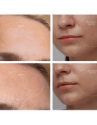 FOREO KIWI™ Derma уред за диамантено микродермабразио и почистване на порите 1 бр.