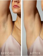 FOREO PEACH™ 2 IPL система превенция срещу растежа на нови косъмчета Peach 1 бр.