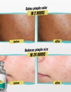 Kiehl's Dermatologist Solutions Truly Targeted Blemish-Clearing Solution серум за кожа с акне за жени 15 мл.