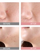 Mizon Good Bye Blemish Pink Spot локален серум с пудра против акне 19 мл.