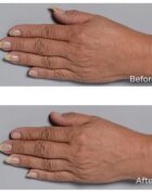 Perricone MD Cold Plasma Plus+ Hand Therapy подхранващ крем за ръце 59 мл.