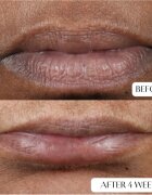 Perricone MD Cold Plasma Plus+ Lip Therapy подхранващ и хидратиращ балсам за устни 4 мл.