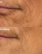Perricone MD Cold Plasma Plus+ The Intensive Hydrating Complex интензивен хидратиращ гел 30 мл.