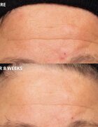 Perricone MD Cold Plasma Plus+ The Intensive Hydrating Complex интензивен хидратиращ гел 30 мл.