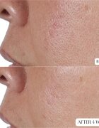 Perricone MD High Potency Face Finishing & Firming Toner стягащ тоник 118 мл.