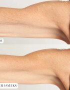 Perricone MD High Potency Intensive Body Therapy интензивен подхранващ крем за тяло 177 мл.