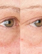 Perricone MD Hypoallergenic Clean Correction Eye Cream хидратираща и озаряваща грижа за клепачи и кръгове под очите 15 мл.