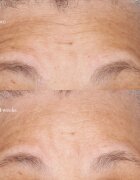 Perricone MD Hypoallergenic Clean Correction Moisturizer Хидратиращ и подхранващ крем 59 мл.