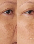 Perricone MD Hypoallergenic Clean Correction Moisturizer Хидратиращ и подхранващ крем 59 мл.