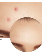 Revox B77 Zitcare AHA BHA PHA Spot Treatment локална грижа против акне 25 мл.