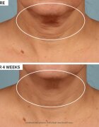 StriVectin Tighten & Lift TL Advanced Tightening Neck Cream Plus стягащ лифтинг крем за шия и деколте 50 мл.