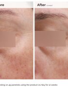 The Ordinary Niacinamide 5% Face & Body Emulsion лека хидратираща емулсия Против тъмни петна за лице и тяло 100 мл.