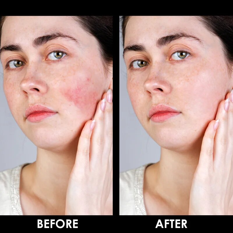 Arval Couperoll Emergency Cream SPF20 крем за редуциране на зачервявания 50 мл.