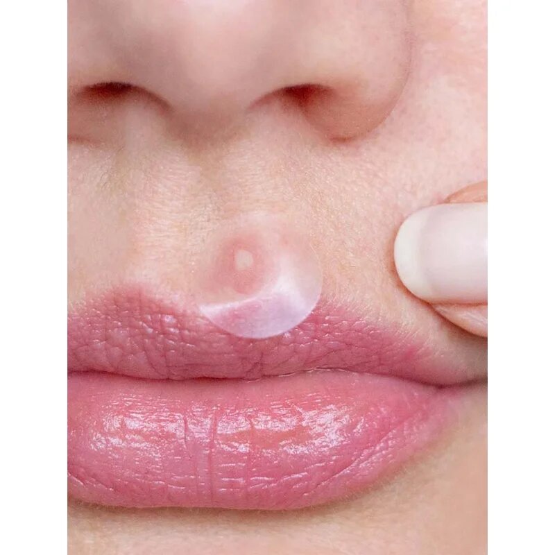 breakout + aid Emergency Dots For Spots and Blemishes локална грижа против акне на лицето деколтето и гърба с Tea Tree oil 72 бр.
