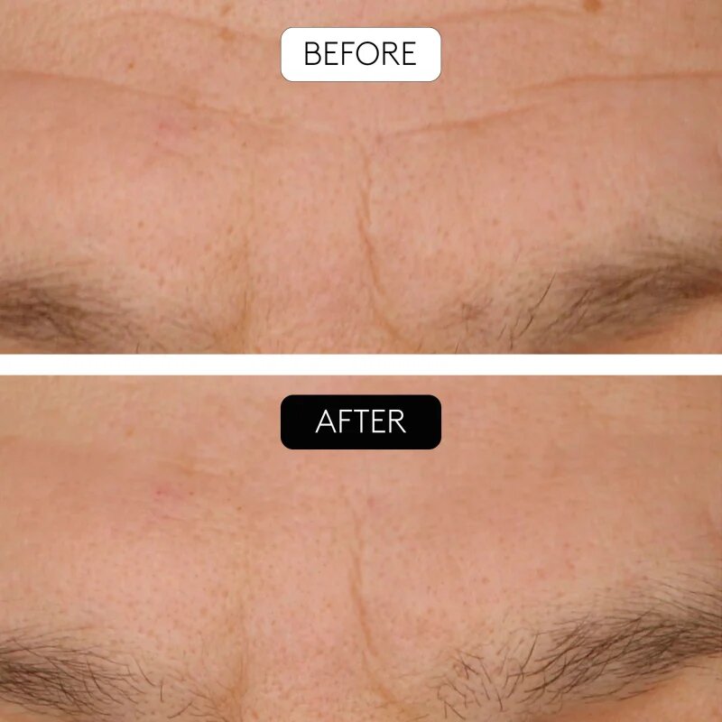 Cocunat Clinical Beauty Filler серум против стареене на кожата с микронидълинг 5 мл.