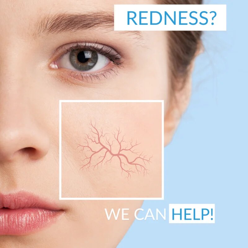 Dermedic Redness Calm мицеларна вода за чувствителна кожа със склонност към почервеняване 500 мл.