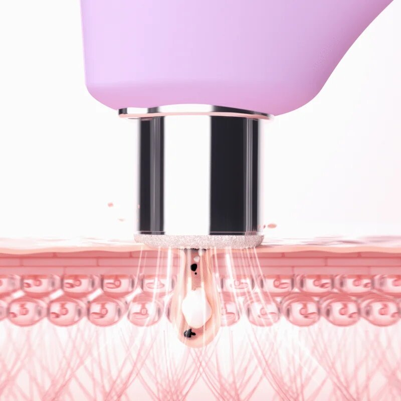 FOREO KIWI™ Derma уред за диамантено микродермабразио и почистване на порите 1 бр.