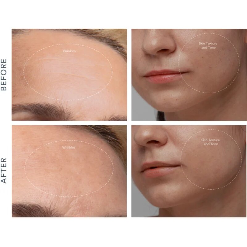 FOREO KIWI™ Derma уред за диамантено микродермабразио и почистване на порите 1 бр.