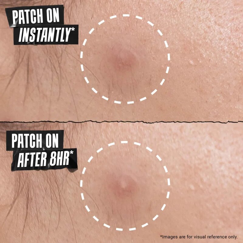 Kiehl's Truly Targeted Overnight Blemish Patch лепенки за проблемна кожа за жени 22 бр.