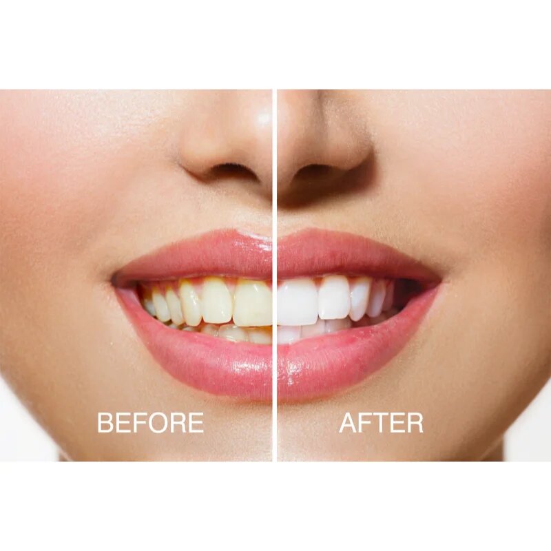 RIO USB teeth whitening комплект за избелване на зъби