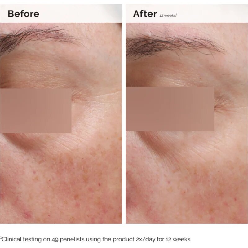 The Ordinary Niacinamide 5% Face & Body Emulsion лека хидратираща емулсия Против тъмни петна за лице и тяло 100 мл.